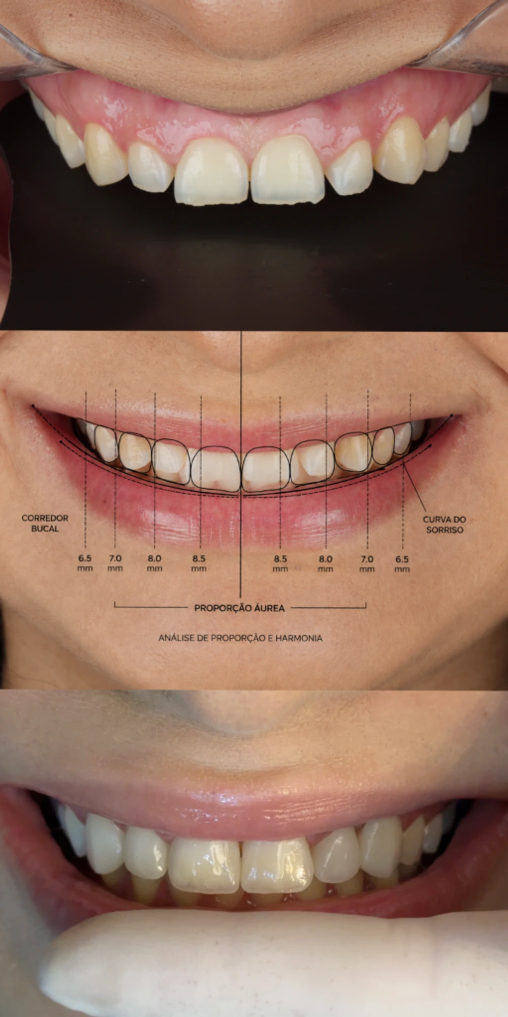 Três etapas do planejamento de um sorriso: o registro inicial, o traçado de proporção e curva do sorriso sobre a foto, e o resultado
