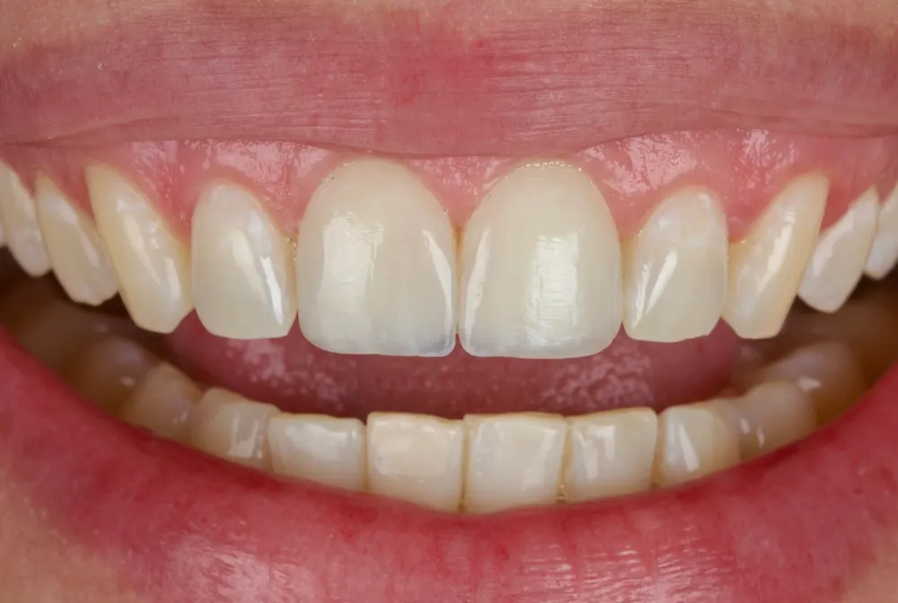 Macro de um sorriso natural: os dentes vão do tom quente junto da gengiva ao marfim claro no corpo e terminam numa borda azulada e translúcida
