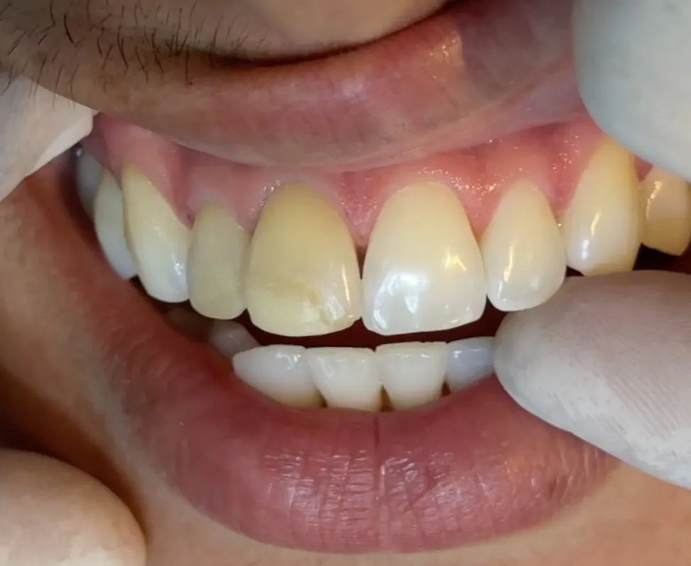Sorriso com um dente escurecido e manchado antes do tratamento