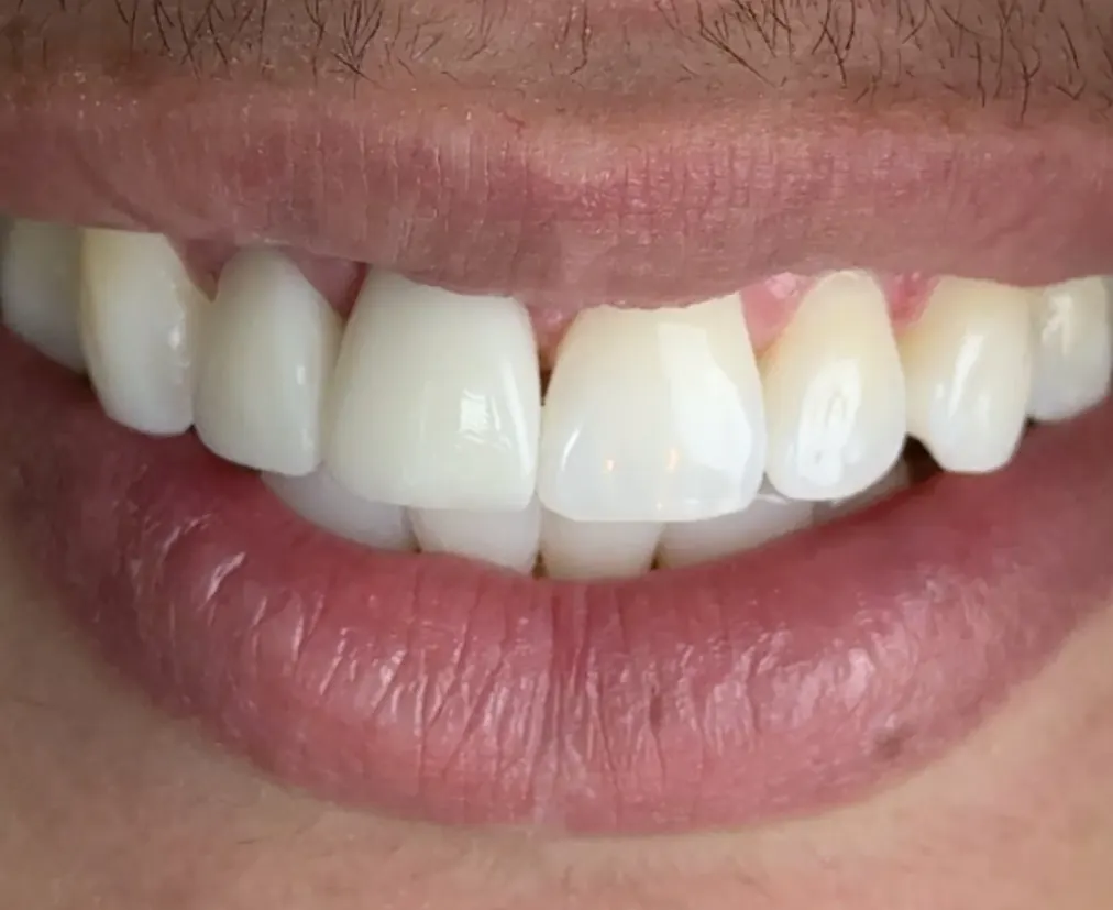 O mesmo sorriso após a reconstrução, sem diferença visível entre os dentes