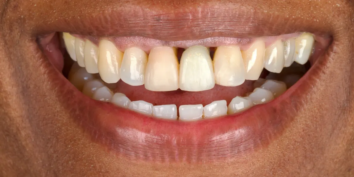 Sorriso com dentes desgastados, amarelados e espaçados antes do tratamento