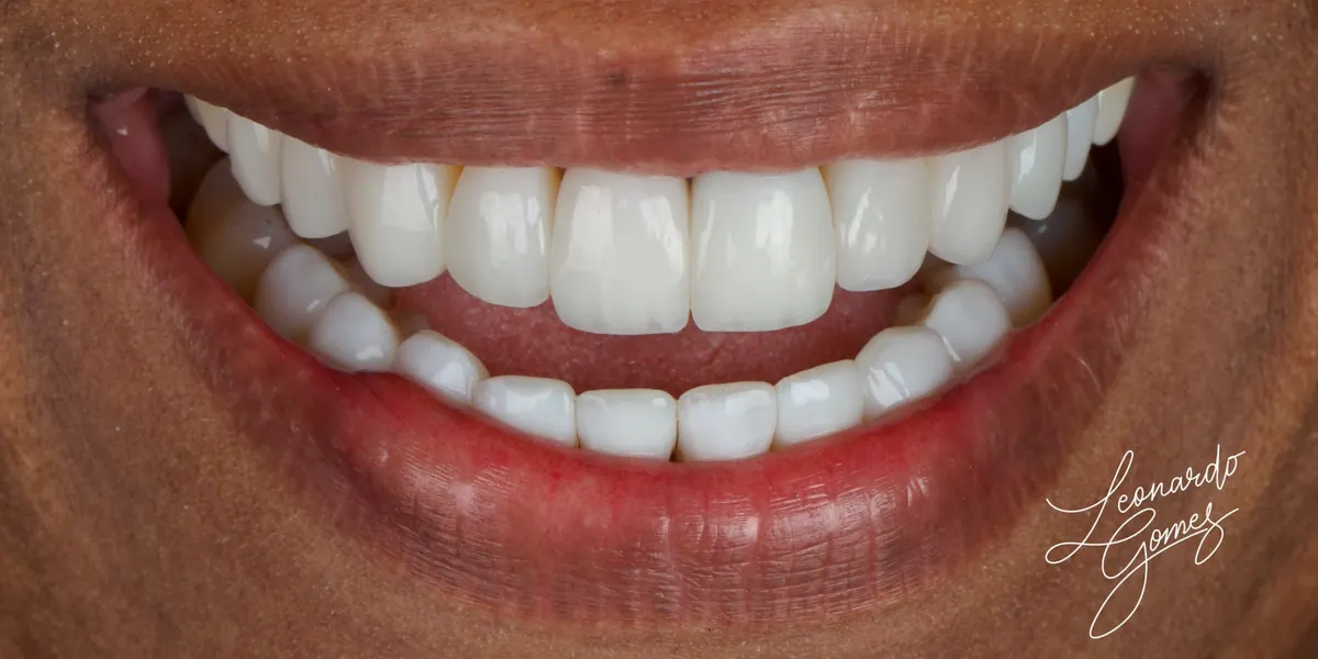 O mesmo sorriso reabilitado, com dentes alinhados e proporcionais