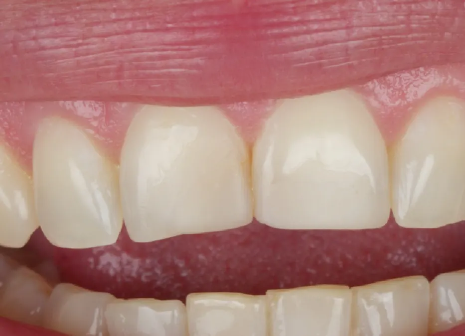 Detalhe dos dentes centrais com falhas na borda, antes do tratamento