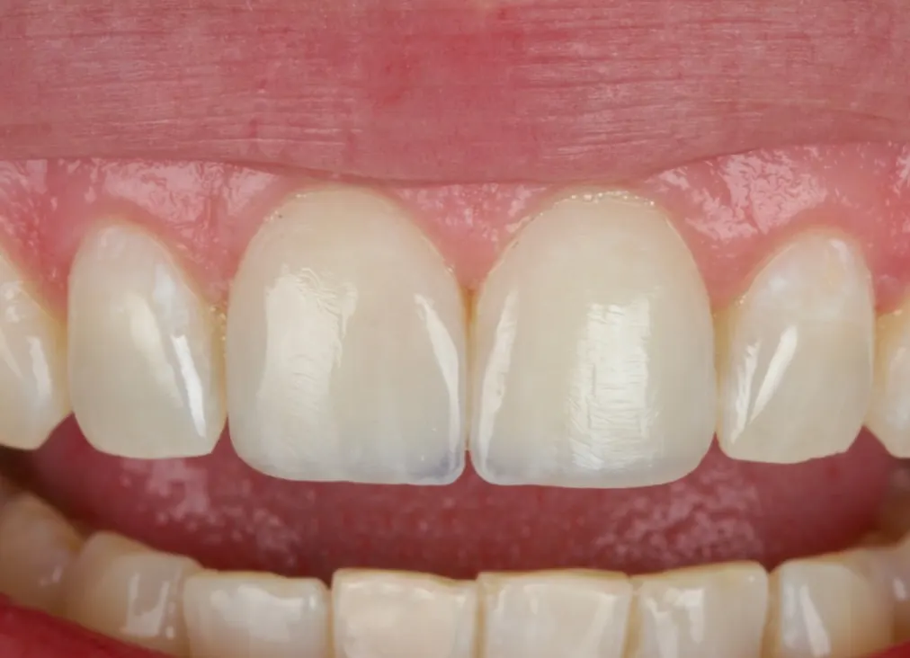 Os mesmos dentes com as falhas corrigidas, mantendo a cor original