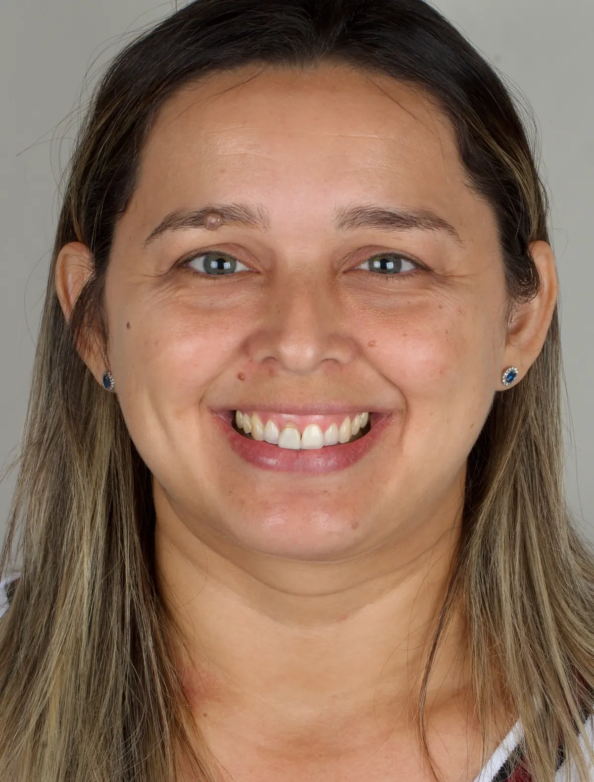Rosto inteiro da paciente antes do tratamento, com os dentes da frente amarelados e de alturas diferentes