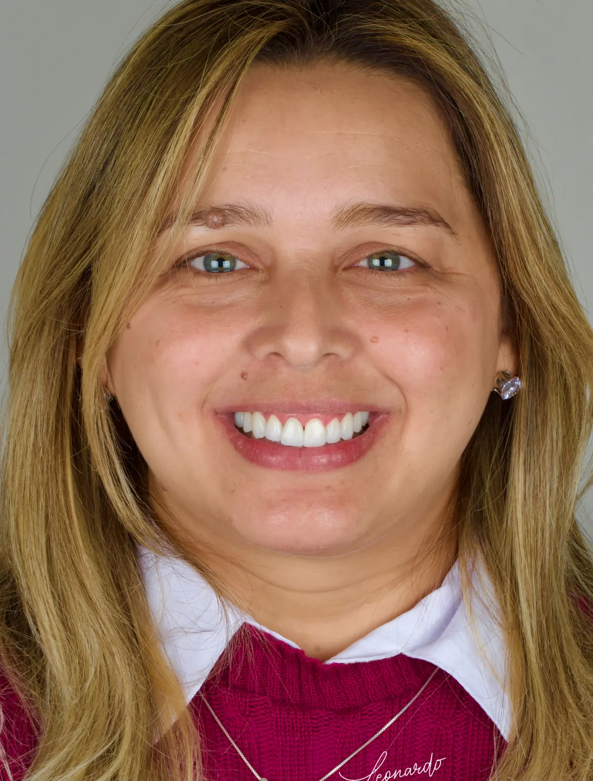 Rosto da mesma paciente depois do tratamento, com o sorriso alinhado e proporcional ao rosto