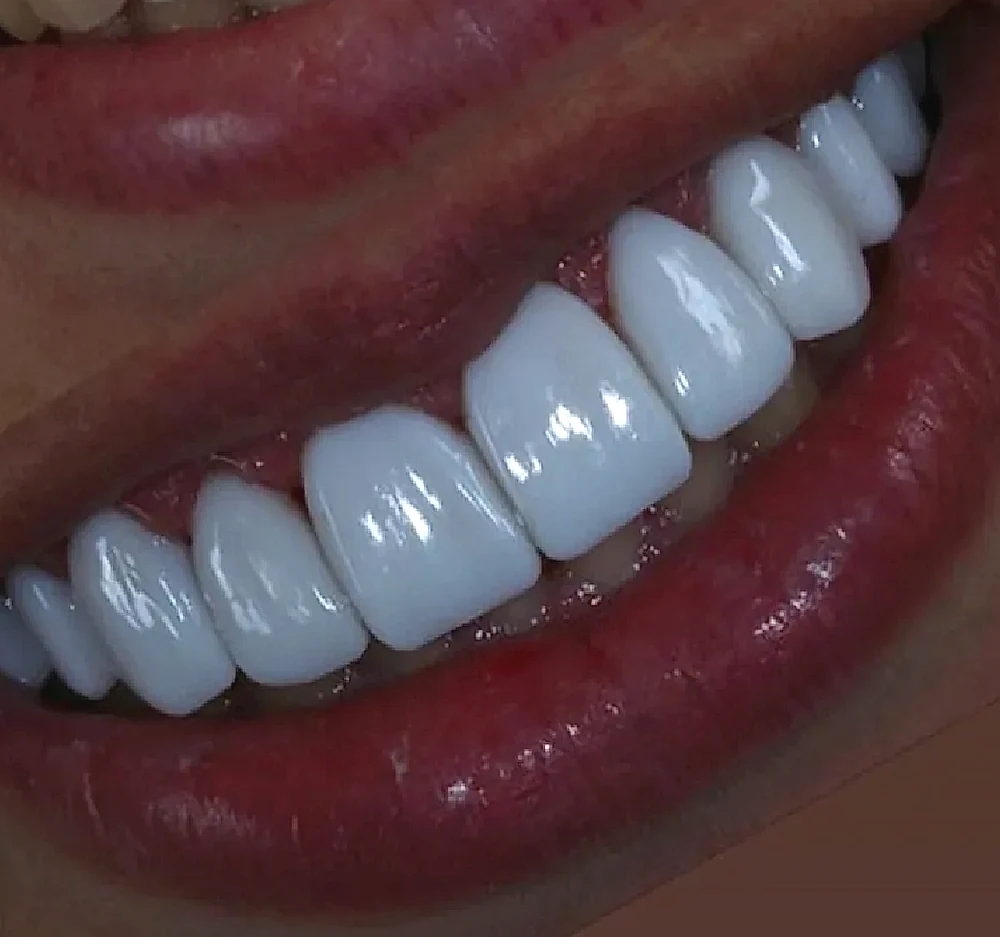 Sorriso com facetas de composição única: todos os dentes na mesma cor branca opaca, sem variação da gengiva até a borda