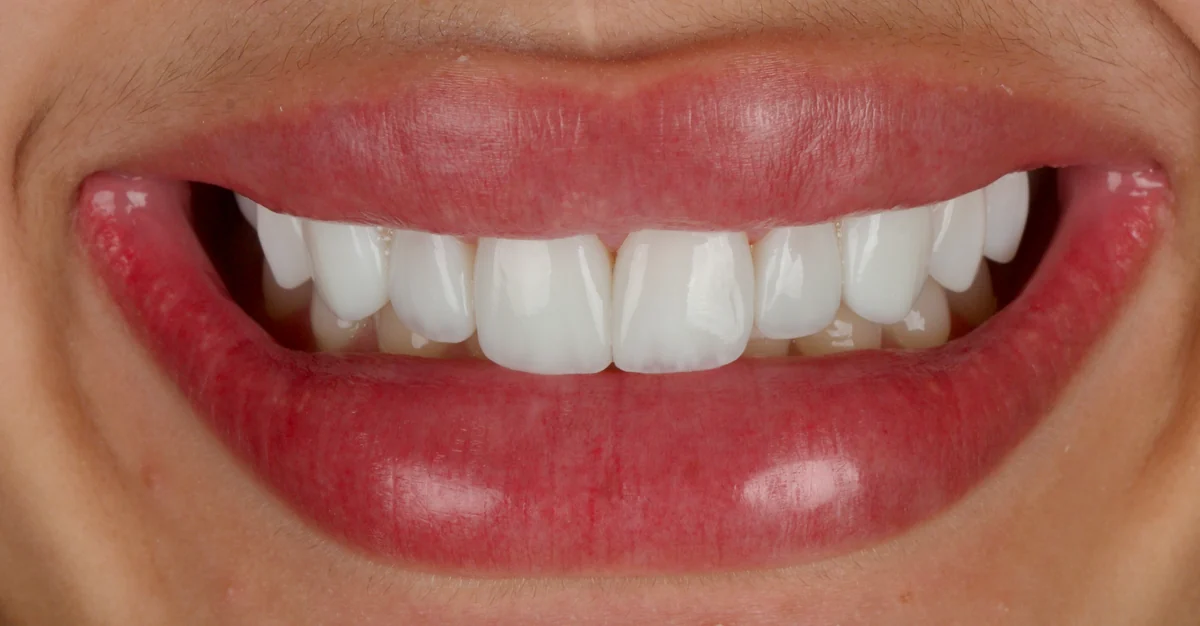 Sorriso feminino após facetas, com dentes claros e formato delicado