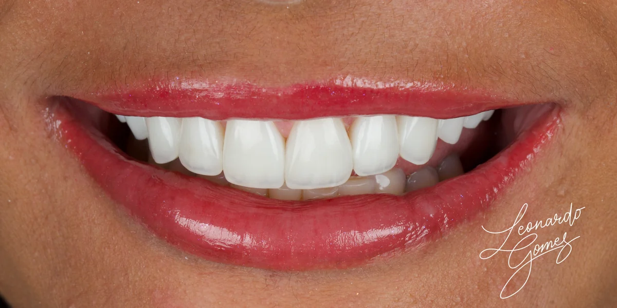 Sorriso feminino amplo após facetas, com dentes claros e lábios definidos